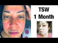 1 Month Withdrawing Topical Steroids | TSW