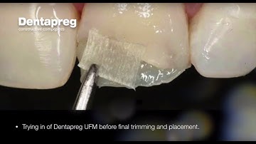 Restoration of Chipped Incisal Edge by Dr. Dennis Hartlieb