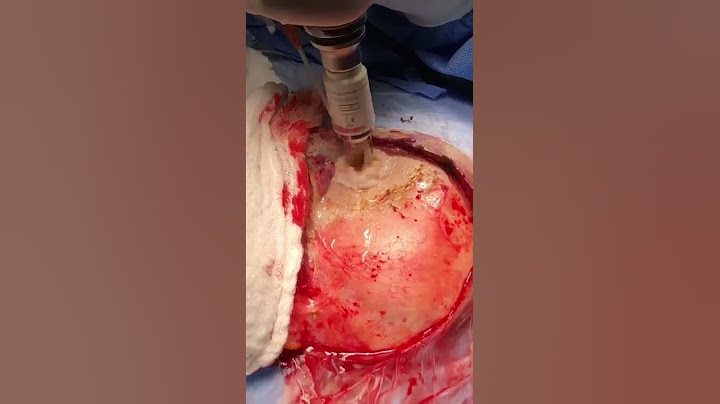 CRANIOTOMIA - ETAPAS DA CIRURGIA #shorts #saude
