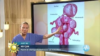 Myom Drabbar En Tredjedel Av Alla Kvinnor - Nyhetsmorgon Tv4