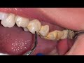 CALCULUS REMOVAL | Dokter Gigi Tri Putra