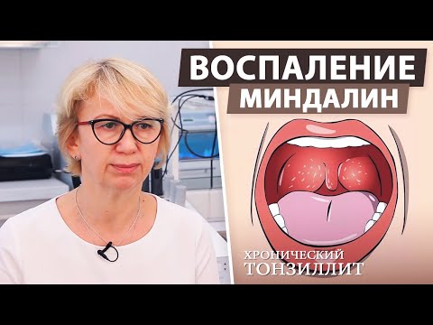 Страдаете хроническим тонзиллитом? Что можно сделать с воспалением миндалин