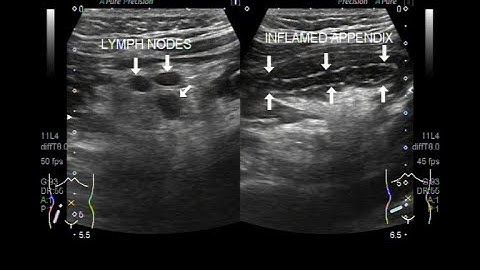 Ultrasound Video showing Inflamed Appendix with prominent lymph nodes in adjacent area.
