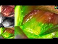 ICG angiography after total thyroidectomy