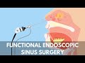 What is a Functional Endoscopic Sinus Surgery?