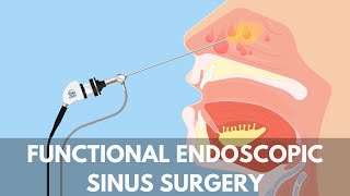 What is a Functional Endoscopic Sinus Surgery?