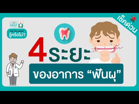 4 ระยะของอาการฟันผุ | คุณหมอฝากมา Ep.30 @COSDENTBYSLC