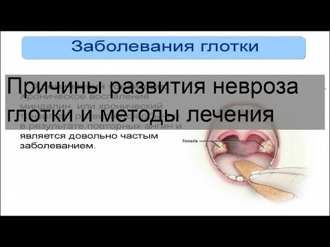 Причины развития невроза глотки и методы лечения