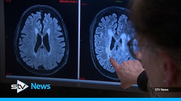 Could retinal scanning help detect the signs of dementia?