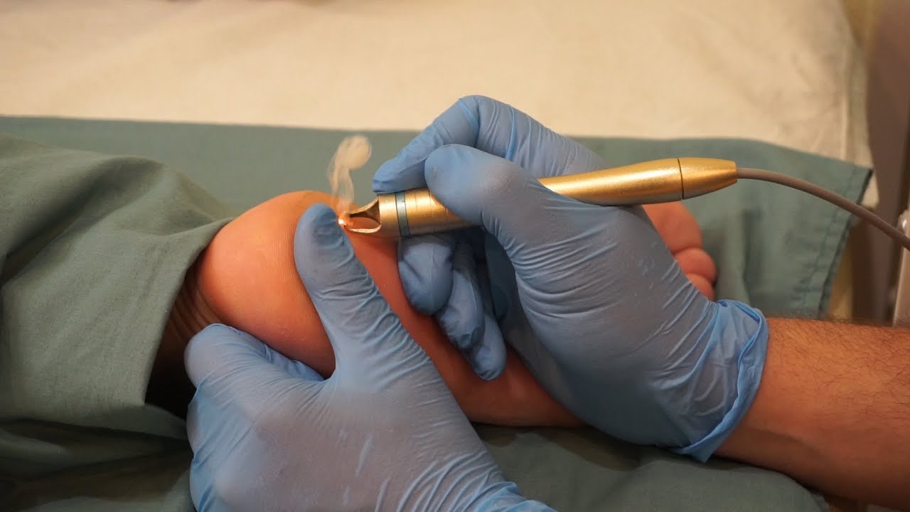 Как Удалить Стержневую Мозоль Диодным Лазером