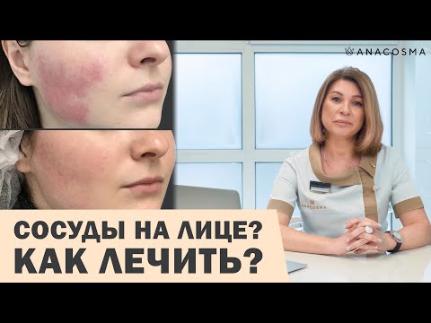 СОСУДЫ НА ЛИЦЕ: КУПЕРОЗ, РОЗАЦЕА ИЛИ ГЕМАНГИОМА 😱⛔️ КАК ЛЕЧИТЬ⁉️