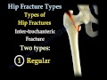 Hip Fractures, Types  and fixation - Everything You Need To Know - Dr. Nabil Ebraheim