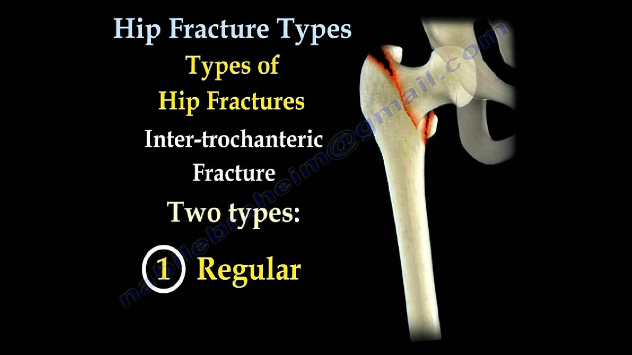 Procedure for Femoral Intertrochanteric Fractures using the “Three‐Finger  Method” Assisted by Proximal Femoral Nail Antirotation - Cheng, MD - 2020 -  Orthopaedic Surgery - Wiley Online Library