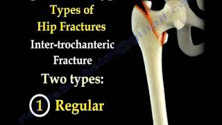 Hip Fractures, Types  and fixation  Everything You Need To Know  Dr. Nabil Ebraheim