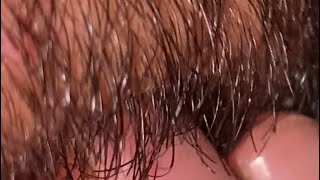 ASMR ingrown hair removal hair satisfying hair beard hair color hair satisfying