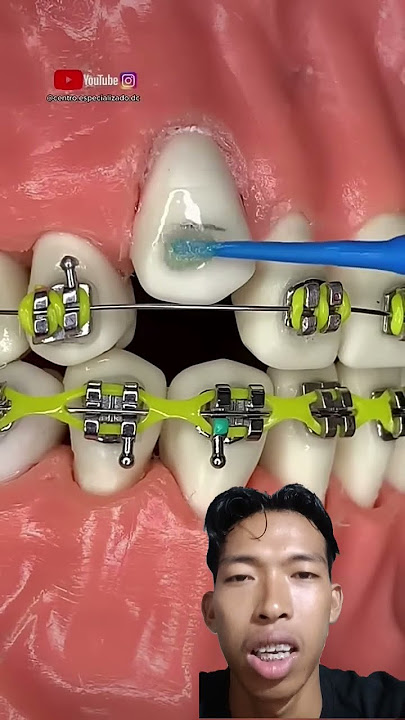 cara pemasangan behel gigi