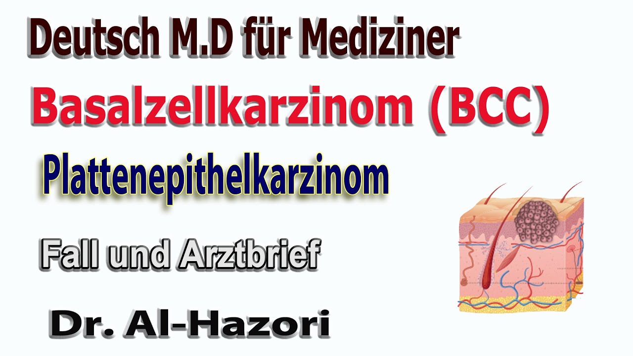 maligner epithelialer Tumore (Basaliom),  Fall, Deutsch M.D für Mediziner, سرطان الجلد الحرشفي