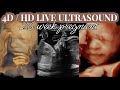 4D HD LIVE ULTRASOUND AT 26 WEEKS | Second pregnancy UK