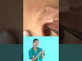 Dr.Nattacha, blackheads ears extraction.