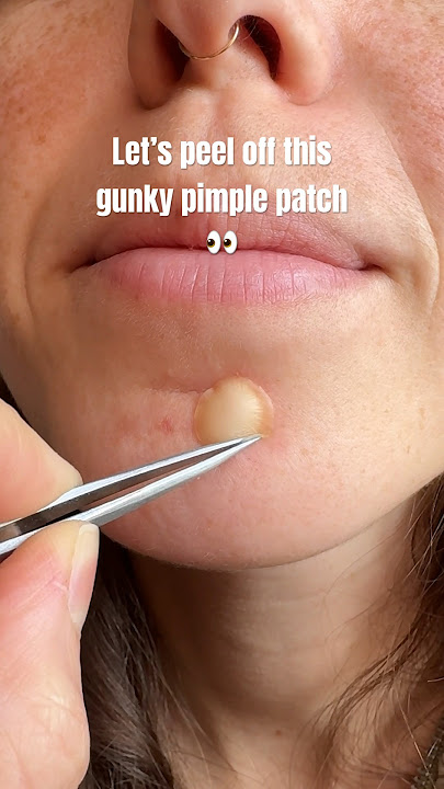 😳🕶️🤏 #pimplepatch #pimplessolution
