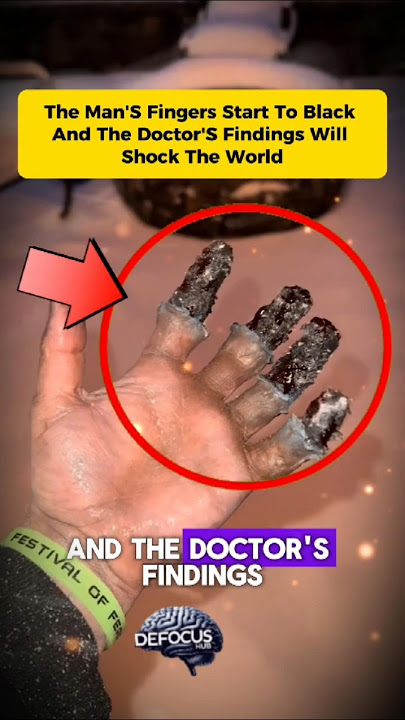 Man’s Fingers Turn Black—Doctor’s Discovery SHOCKS The World #doctorshocked #blackfingers