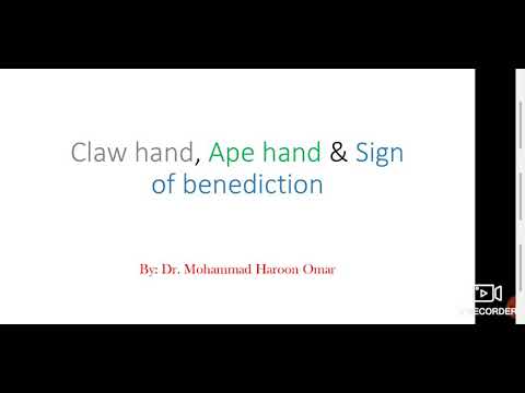Video: Ape Hand: Mediana živca, Simptomi, Vzroki, V Primerjavi Z Roko Krempljev