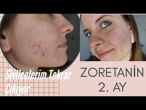 ZORETANİN 2. AY BİTTİ | Sivilcelerim Tekrar Çıkıyor !😑