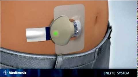 How to insert the Medtronic MiniMed Enlite sensor - diabetes therapy