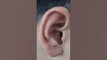 Tinnitus EXPOSED - Surprising Causes of Ringing in Ears #8 Meniere