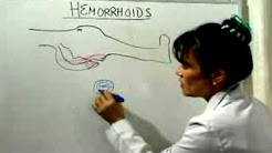 Hemorrhoid Cure: What Causes Hemorrhoids