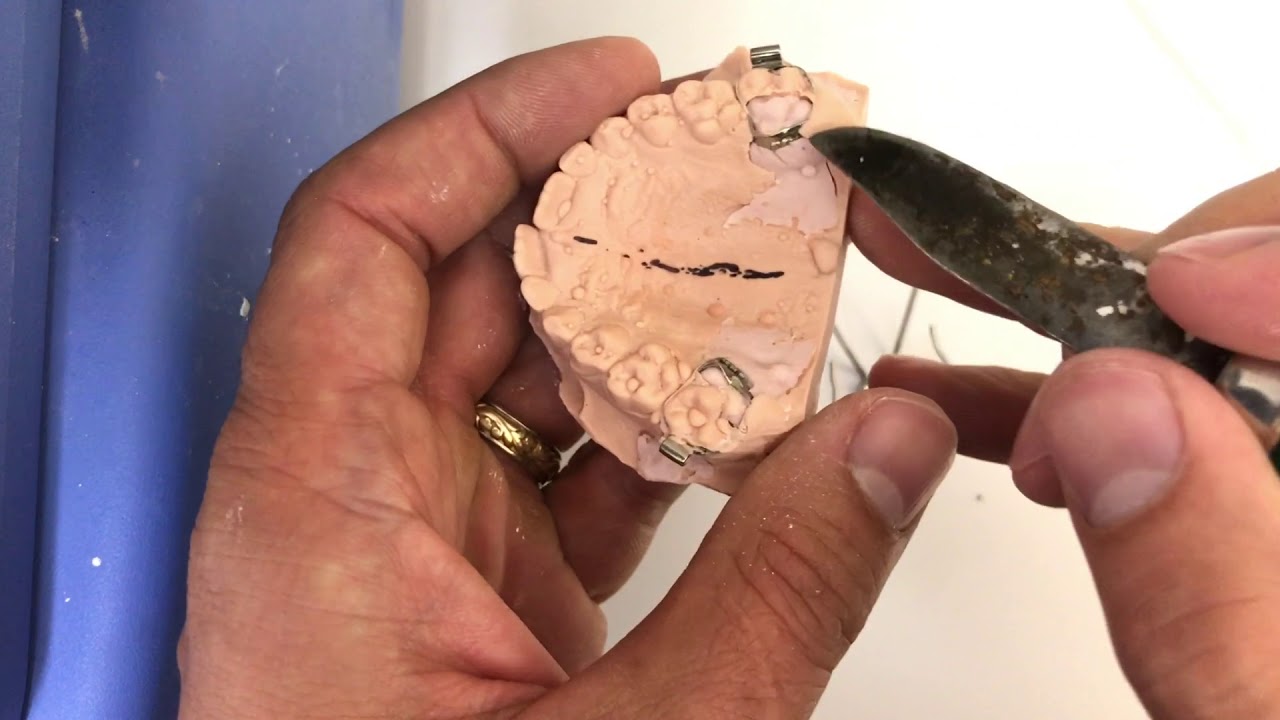 Complete fabrication of orthodontic RPE appliance - YouTube