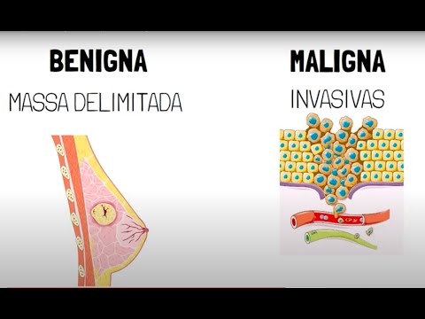 Vídeo: A neoplasia é benigna ou maligna?