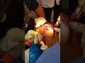 FUE follicular unit extraction (injerto capilar)