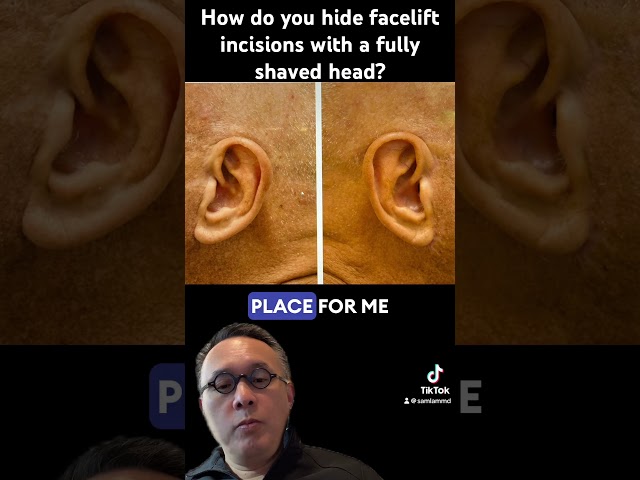 How do you hide facelift incisions with a fully shaved head?