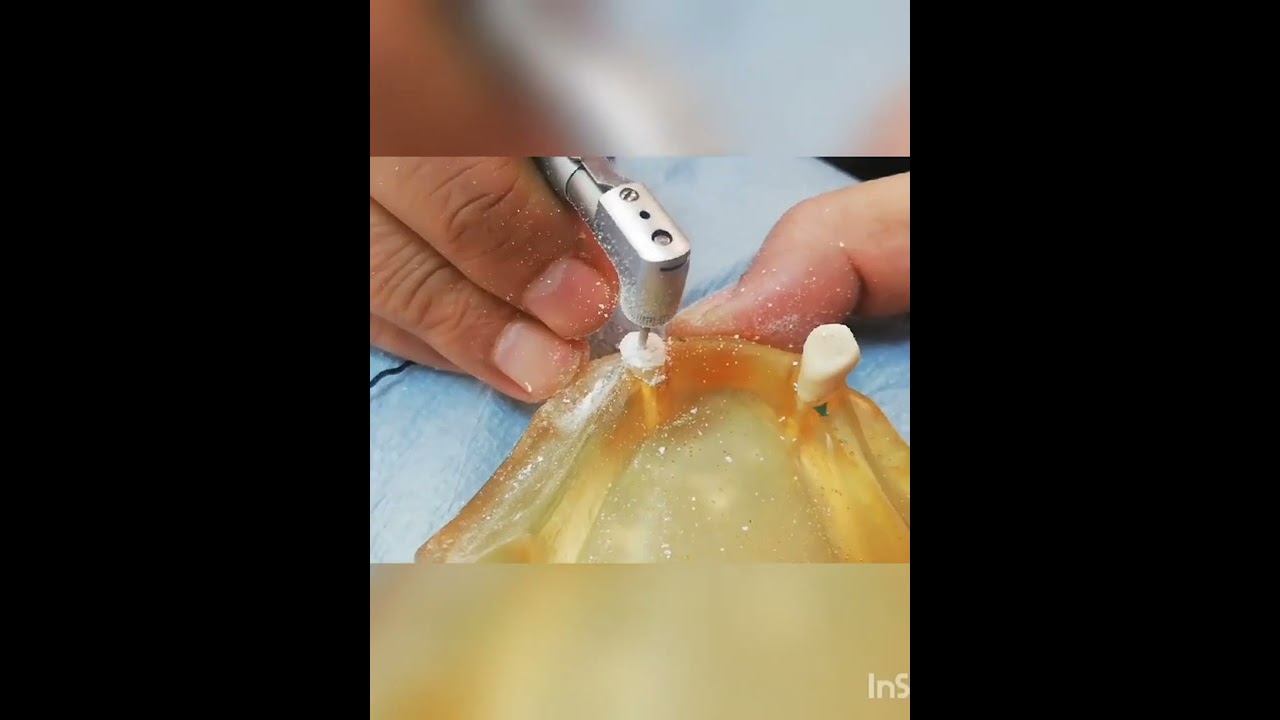 overdenture abutment preparation with amalgam plug