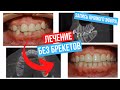 Invisalign - Лечение без брекетов. Элайнеры. Как работает система? Разбор случая в прямом эфире.