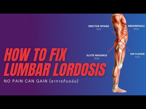 HOW TO FIX LUMBAR LORDOSIS : อาการก้นแอ่นและการแก้ไข