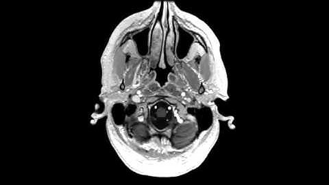 High-resolution whole-brain DCE-MRI using constrained reconstruction: Prospective clinical