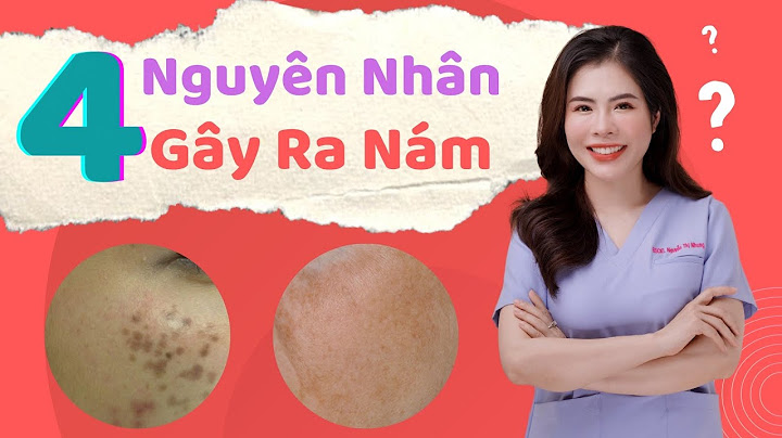 Nguyên nhân của nám da