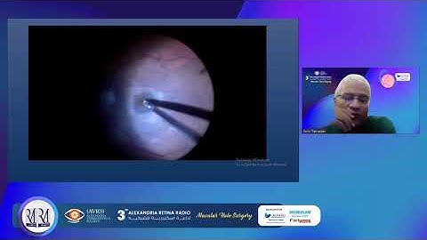 The webinar of “ MACULAR HOLE SURGERY”