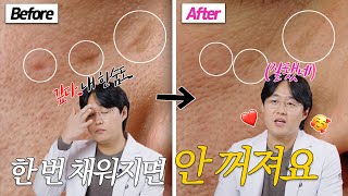 흉터치료, 방법만 알면 쉬운데 왜 방치해요? #수두흉터 #패인흉터 #새살침