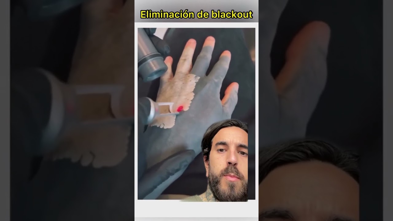 Se ELIMINA su BLACKOUT con LÁSER 😣😖🫣