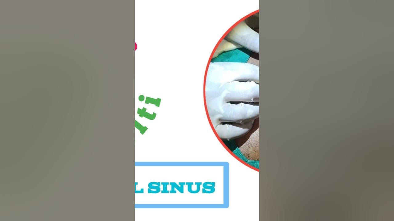 Pilonidal sinus / Pilonidal plasty / Laser ablation / Nadivrana YouTube