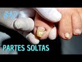 UNHA DESLOCADA COM INFILTRAÇÃO E FUNGO ( "NAIL LOVERS" )#PODOLOGOMAURELIO #PODOLOGIA#UNHAENCRAVADA