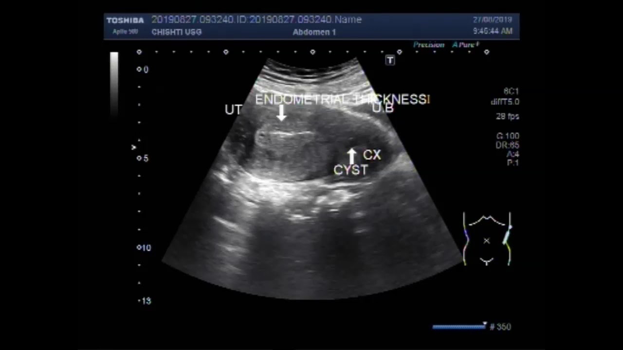 Ultrasound Video showing Endometrial hyperplasia of uterus. - YouTube