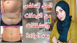 علاج تشققات البطن و الخطوط الحمراء و الترهل بعد الولاده و الخطوات للحصول على بطن مسطح