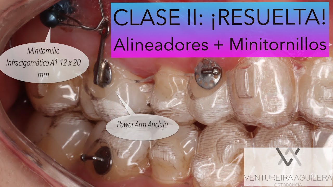Corrige CLASES II Fácilmente: Distalamiento Secuencial con ALINEADORES + MINITORNILLOS