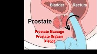 Prostate Massage, Prostate Orgasm, Prostate Cancer, and Male P-Spot