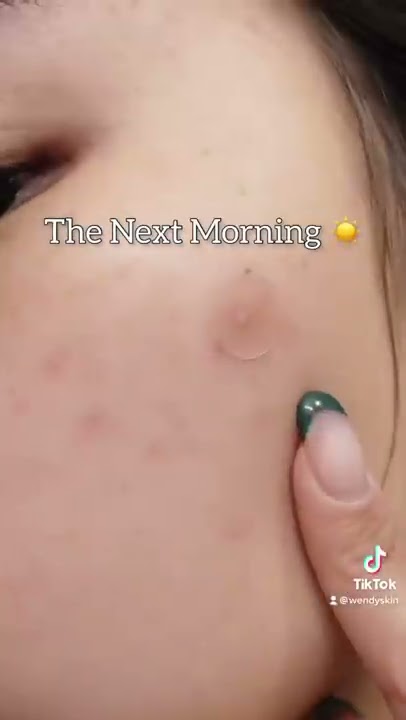 testing out my ✨PIMPLE PATCH✨ (disappointed)