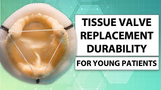 Tissue Heart Valve Replacement Durability for Young Patients with Dr. Patrick McCarthy